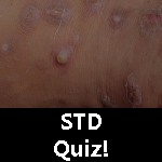 STD Quiz